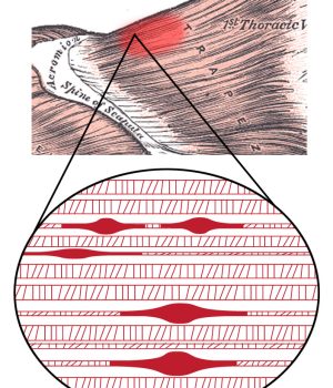 Trigger_Point_Complex